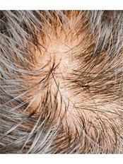 Natural Treatment for Female Pattern Hair Loss - New Man Clinic