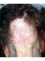 Alopecia Areata Treatment - New Man Clinic