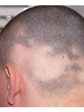 Alopecia Areata Treatment - New Man Clinic