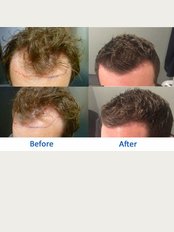 Better Hair Transplant Clinics - Coventry - 4 Queen Victoria Road, Coventry, CV1 3JH, 