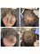 Leeds Hair Loss Clinic - HLC Laser Treatment 