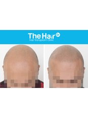 Scalp Micropigmentation - The Hair Dr
