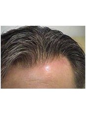 Treatment for Male Pattern Baldness - Total Hair Loss Solutions