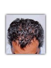 Hair Loss Treatment - Total Hair Loss Solutions