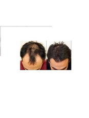 Hair Loss Specialist Consultation - Total Hair Loss Solutions
