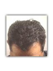 Hair Loss Treatment - Total Hair Loss Solutions