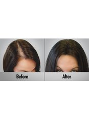 Acell Hair Loss Therapy - The Hair Transplant Center