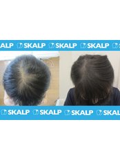 Hair Thinning Treatment ( SMP Thickening ) - Skalp USA