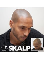 Scalp Micro Pigmentation (Receding hairline) - Skalp USA