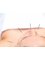 Carahealth Acupuncture Naturopathy Homeopathy - Carahealth offers a Life Extension Programme and Cosmetic Acupuncture for Facial rejeuvenation 