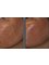 Biomedical Clinics - melasma (brown marks) before and after 