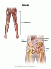 Sciatica Treatment - Energise Therapy,Sports Injury and Shockwave Therapy Clinic