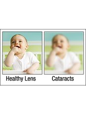 Cataract Treatment - Neurosurgery clinic