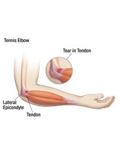 Tennis Elbow - Neurosurgery clinic