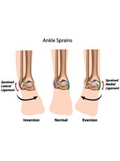 Ankle Injury Treatment - Neurosurgery clinic