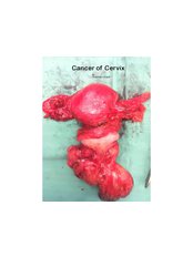 Cervical Cancer Treatment / Surgery - Klinik Dr Zaharuddin KL Gynaecologist