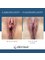 Ebru Unal Cosmetic Gynecology Clinic - Labiaplasty + Vaginoplasty before-after photo 