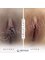 Ebru Unal Cosmetic Gynecology Clinic - Labiaplasty before-after photo 