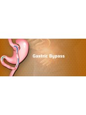Gastric Bypass - Group Florence Nightingale Hospitals