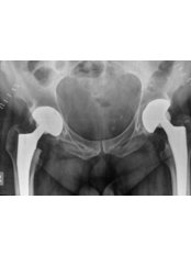 Hip Replacement - Dr. Shivkumar Santpure - Joint Replacement - Orthopedic Surgeon
