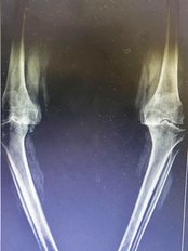 Knee Replacement - Dr Deepak Inamdar's Orthopedic and Joint Replacement Center