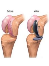 Joint Replacement Surgery - Orthopedic Surgery Centre Bangalore