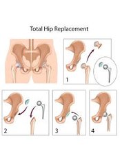Hip Replacement - Orthopedic Surgery Centre Bangalore