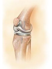 Joint Replacement Surgery - Orthopedic Surgery Centre Bangalore