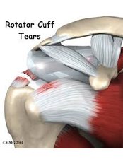 Rotator Cuff Repair - Paediatric Orthopaedics India