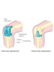 Knee Replacement - Paediatric Orthopaedics India