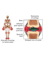 Rheumatoid Arthritis Treatment - Spine Care & Ortho Care