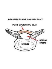 Laminectomy - Spine Care & Ortho Care