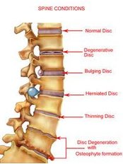 Laminectomy - Bangalore Spine Care Super Speciality Clinic and Research Centre