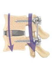 Spinal Fusion - Bangalore Spine Care Super Speciality Clinic and Research Centre