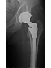 Hip Replacement - Isomer