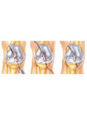 Knee Reconstructive Surgery - Isomer