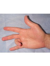 Trigger Finger Treatment - Isomer