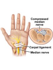 Carpal Tunnel Surgery - Isomer