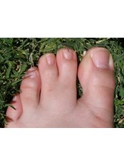 Webbed Toes Surgery - Isomer