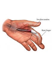 Trigger Finger Treatment - Isomer