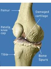 Knee Replacement - Isomer