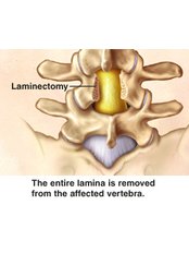 Laminectomy - Isomer