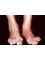 Happy Feet Foot Clinics - Hammertoe deformity in rheumatoid arthritis 