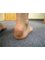 Happy Feet Foot Clinics - Haglund's deformity behind the heel 