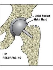 Hip Resurfacing - KIMS - Orthopaedic Hospital India