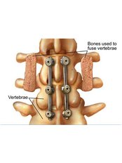 Spinal Fusion - KIMS - Orthopaedic Hospital India