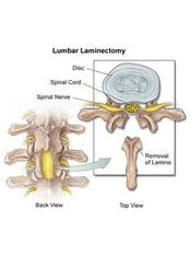 Laminectomy - KIMS - Orthopaedic Hospital India