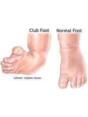 Club Foot Repair - Orthopaedic Clinic
