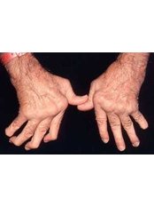 Rheumatoid Arthritis Treatment - Orthopaedic Clinic
