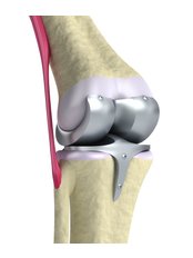 Joint Replacement Surgery - Orthopaedic Clinic